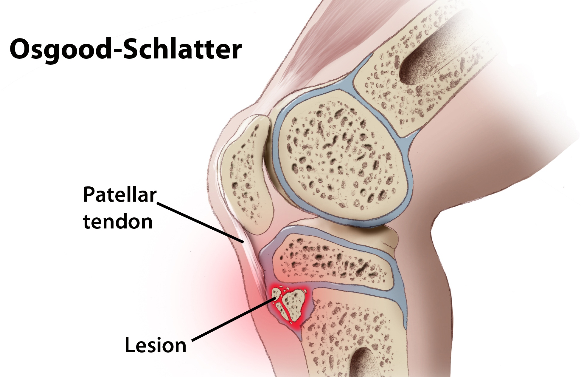 Osgood-Schlatter's syndrome